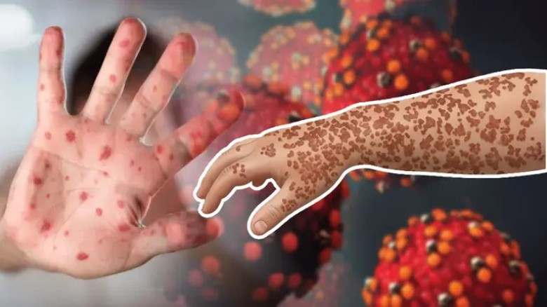Adenovirus Co-Infection Increasing Risks for Measles Patient